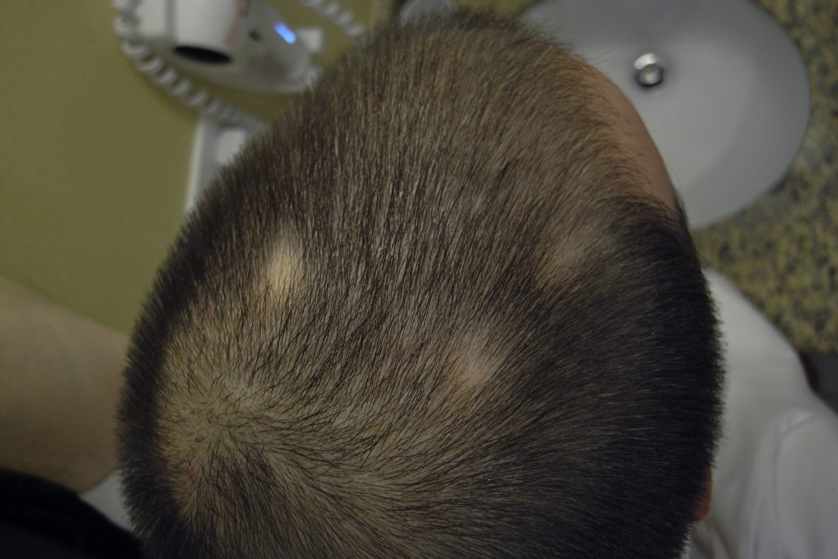 آیا میکروپیگمنتیشن بر درمان آلوپسی پوست سر موثر است؟